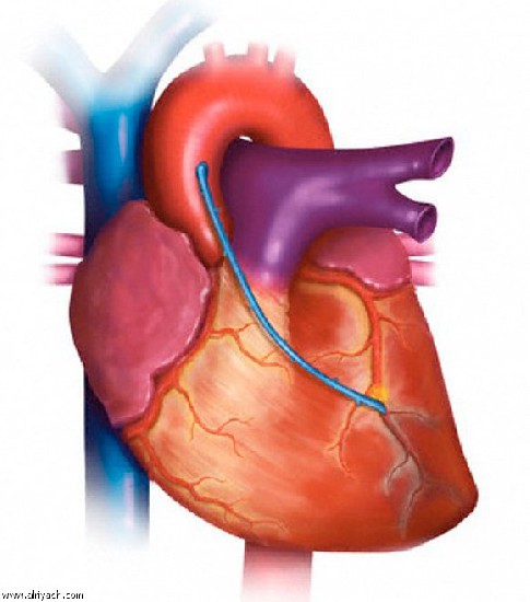 Гипоксия миокарда 

 Это заболевание, развивающейся в результате уменьшения доставки кислорода к сердечной мышце